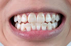 After Treatment
