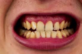 Before Treatment